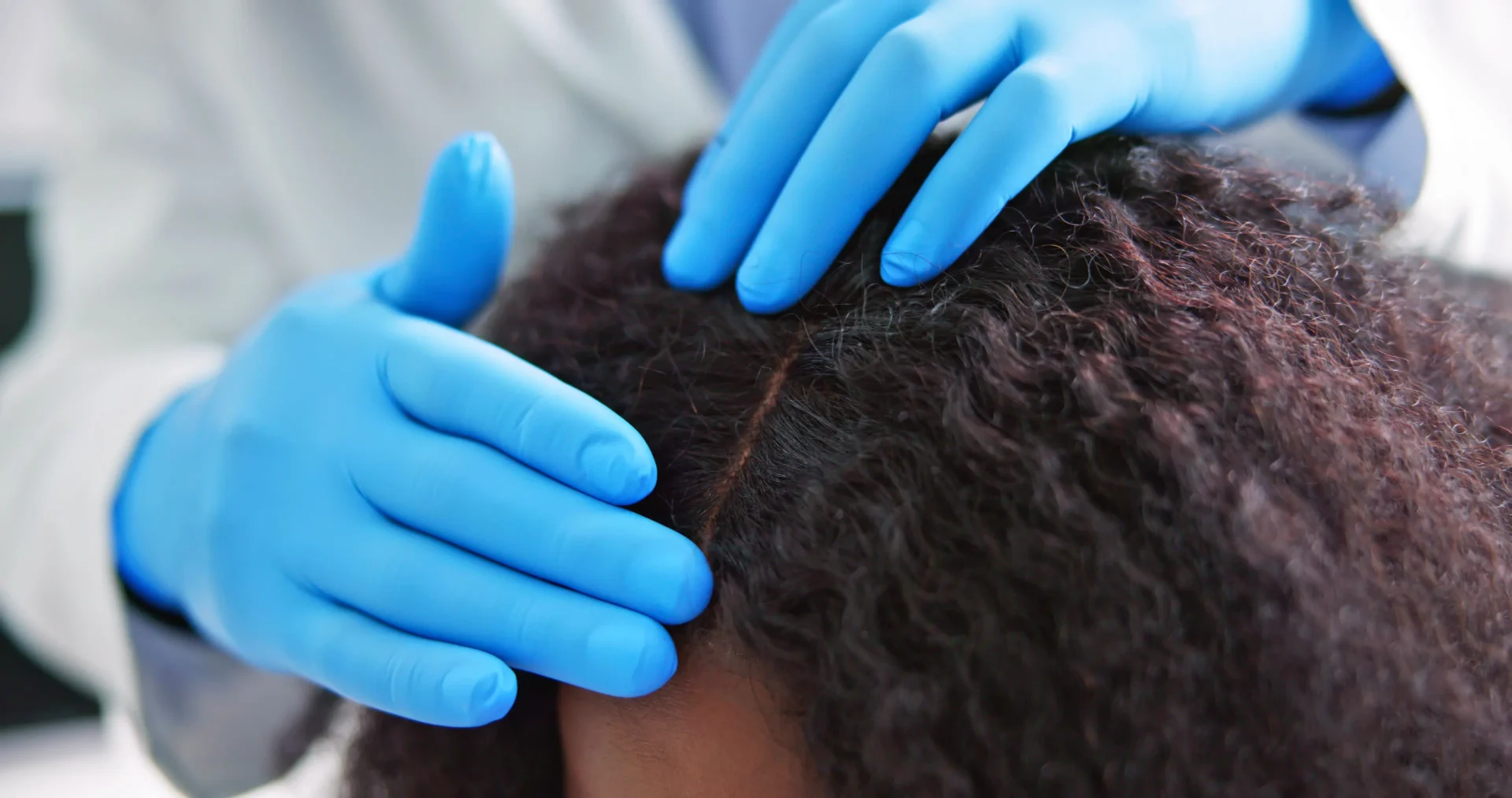 traction-alopecia-treatment